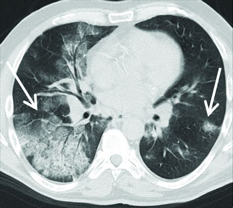 Cryptogenic organizing pneumonia